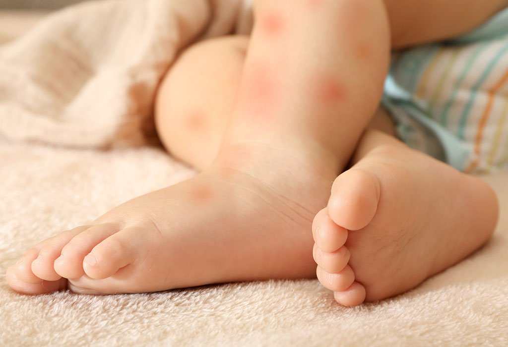 آلرژی به شیر در نوزادان 