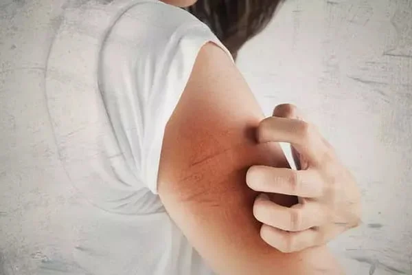 خاصیت زردآلو در درمان اختلالات پوستی