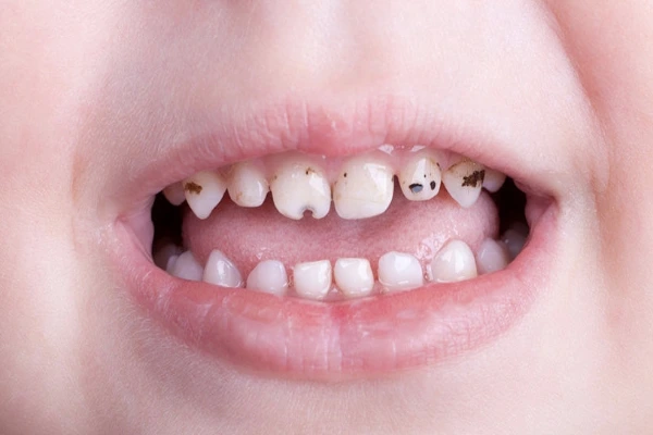 پوسیدگی ناشی از شیشه شیر